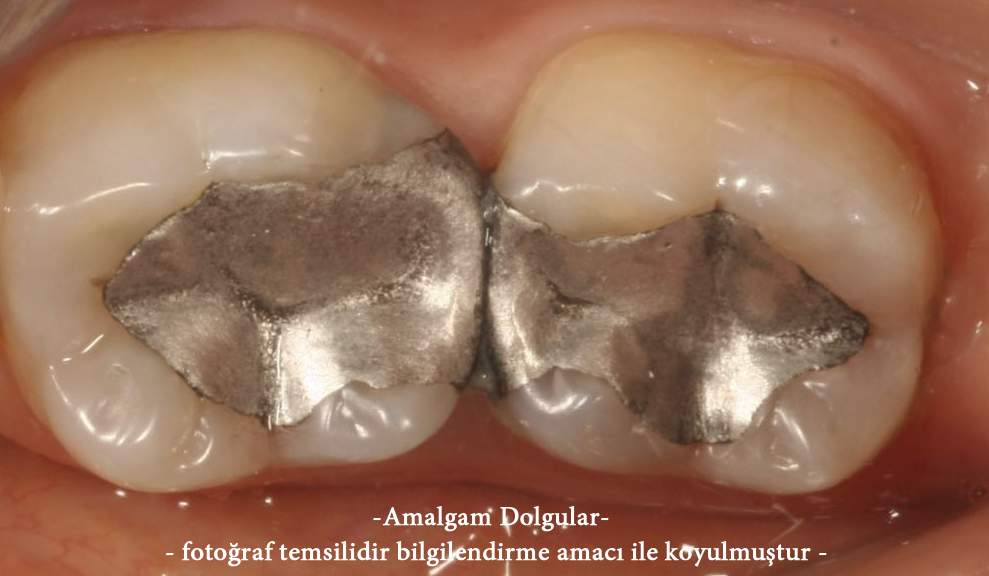 Amalgam dolgu 3