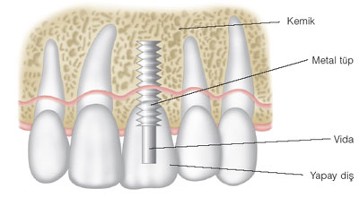 dis-ve-agiz-sagligi-implant-56-01