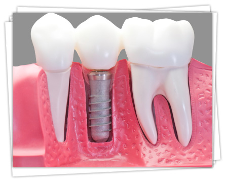 implant-nedir