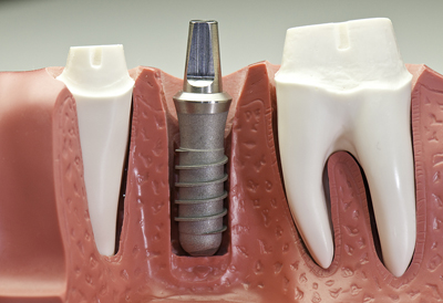 Dental Implant Model