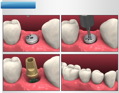 implant-once-sonra-2