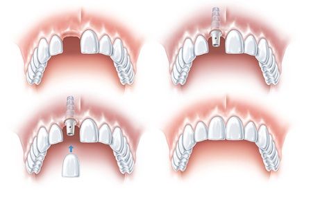 implant10