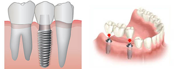 implant_nedir