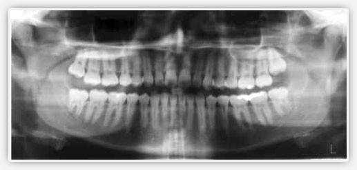 panoramik-dis-rontgeni