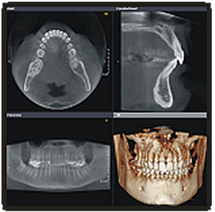 Dental Tomografi