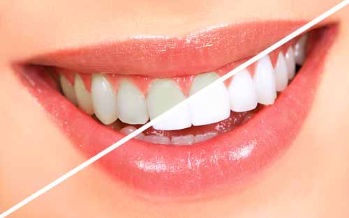 Ev-Tipi-Diş-Beyazlatma-Sistemleri