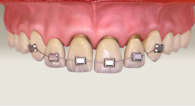 Ortodontik tedavi hangi yaşlarda yapılır