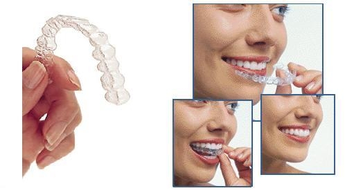 Invisalign