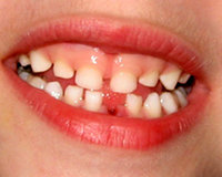 Kalıcı diş çıkarma dönemleri