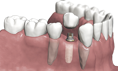 Doğal dişe en yakın çözüm implant tedavisi