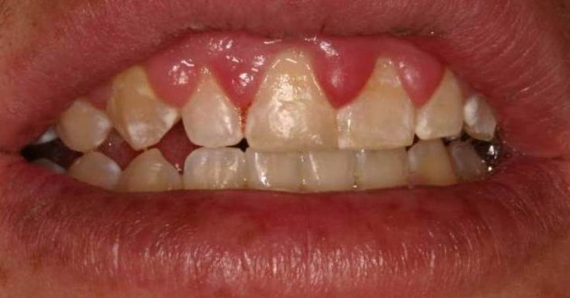 Diş etleri dişlerinizin sağlıklı olup olmadığını gösteriyor